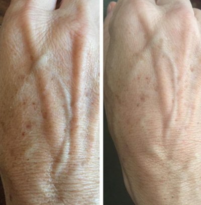 before and after age spots